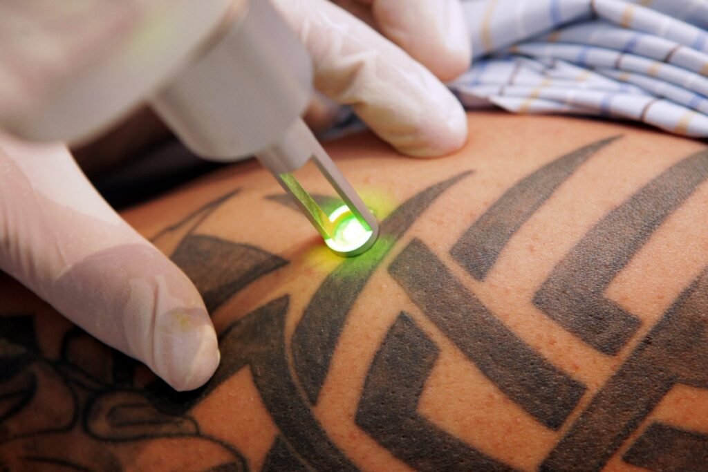 Imgi 209 Remocao De Tatuagens A Laser 1024x683