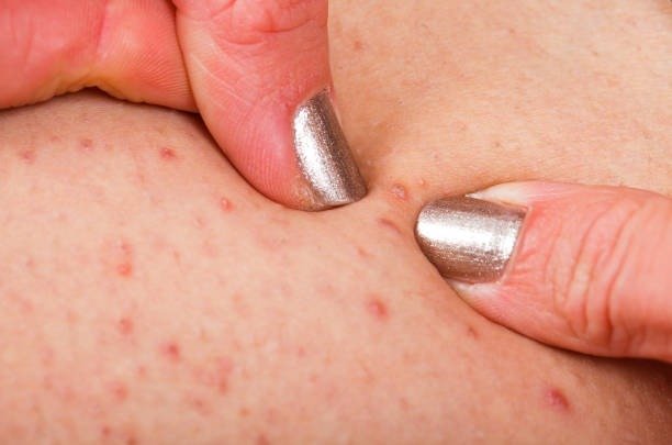 Imgi 4 Folliculitis On Human Skin