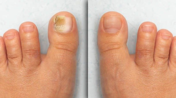 Imgi 6 Before And After Successful Treatment For A Fungal Infection On Big Toe