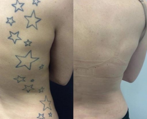 Remoção de Tatuagem a Laser — Maislaser Taboão Depilação a Laser e Tratamentos Dermatoestéticos a laser.