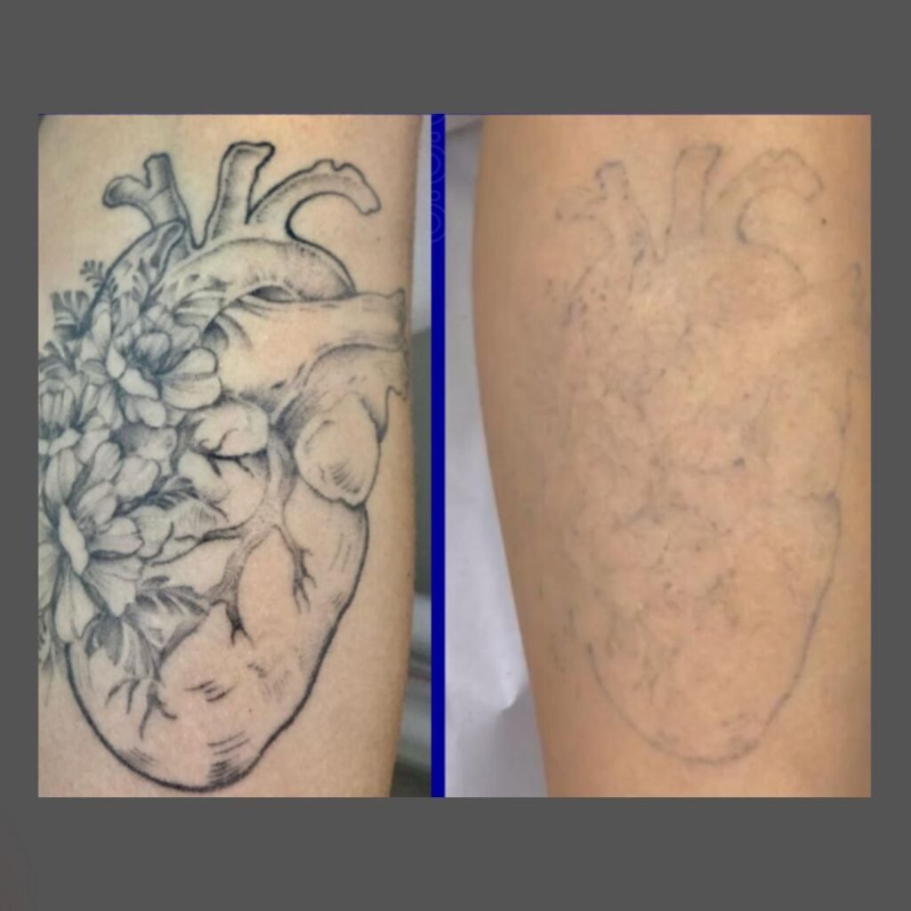 Remoção de Tatuagem a Laser na Maislaser Taboão