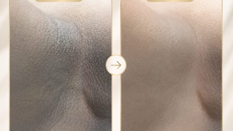 Clareamento Íntimo — Maislaser Taboão Depilação a Laser e Tratamentos Dermatoestéticos a laser.