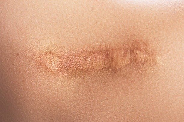 Tratamento a laser para cicatrizes na Maislaser Taboão